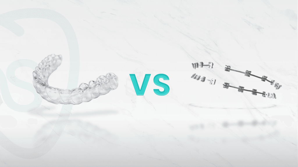 Brackets vs. Alineadores