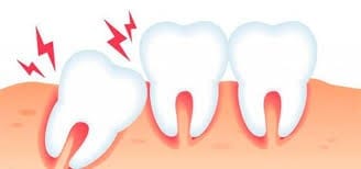 Los dientes vecinos se mueven