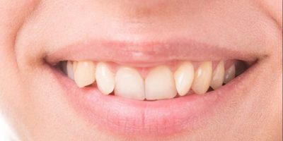 111blog Dientes torcidos