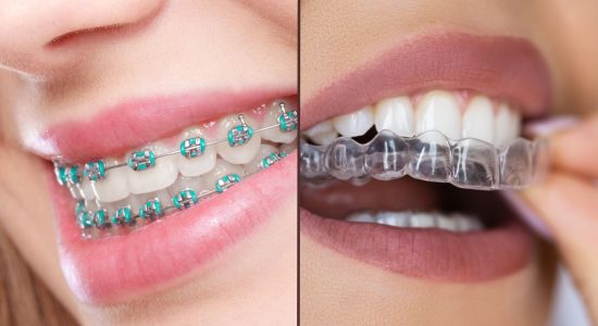 brackets-y-alineadores Braquets vs alineadores