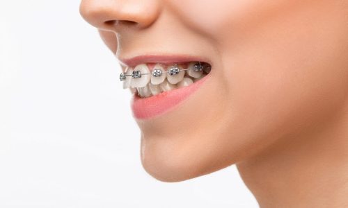 Brackets