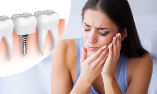 imagen 1 Duelen los implantes dentales